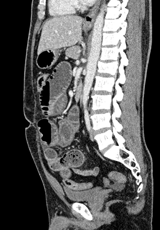 Adhesional small bowel obstruction (Radiopaedia 58900-66131 Sagittal C+ portal venous phase 135).jpg