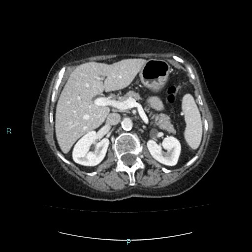 File:Adrenal collision tumor (ACT) (Radiopaedia 48462-53379 Axial C+ portal venous phase 18).jpg