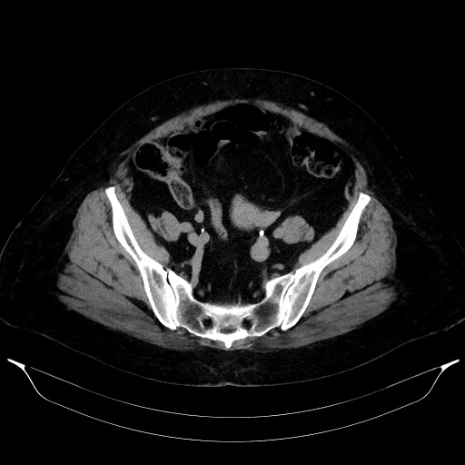 Adrenal cortical carcinoma (Radiopaedia 64017-72769 Axial C+ delayed 61).jpg