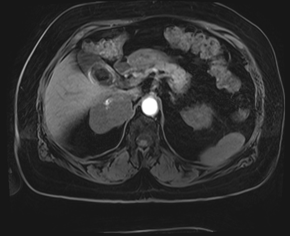 Adrenal cortical carcinoma (Radiopaedia 64017-72770 H 9).jpg