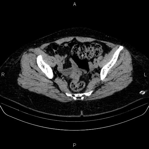 File:Adrenal cortical carcinoma (Radiopaedia 84882-100379 Axial non-contrast 82).jpg