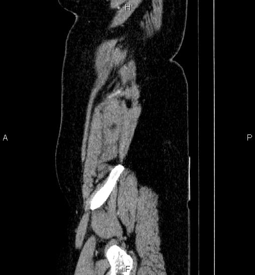 File:Adrenal cortical carcinoma (Radiopaedia 84882-100379 Sagittal C+ portal venous phase 6).jpg
