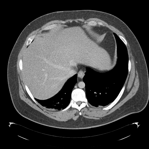 File:Adrenal cyst (Radiopaedia 45625-49776 Axial C+ portal venous phase 15).png