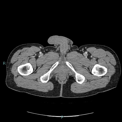 Adrenal cystic lymphangioma (Radiopaedia 83161-97534 Axial C+ portal venous phase 108).jpg