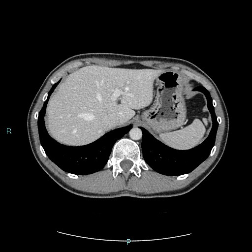 Adrenal cystic lymphangioma (Radiopaedia 83161-97534 Axial C+ portal venous phase 19).jpg
