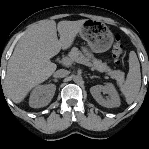 Adrenal gland trauma (Radiopaedia 81351-95079 Axial non-contrast 35).jpg