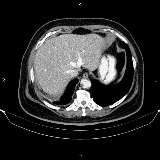 Adrenal hemorrhage (Radiopaedia 62622-70916 Axial C+ portal venous phase 20).jpg