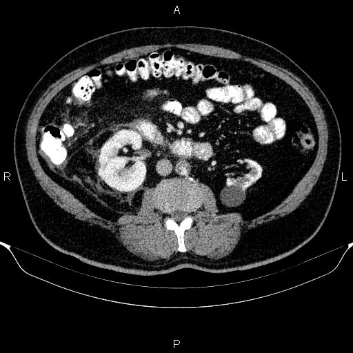 Adrenal hemorrhage (Radiopaedia 62622-70916 Axial C+ portal venous phase 93).jpg