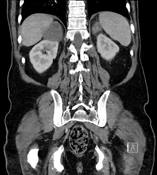 Adrenal lymphoma (Radiopaedia 73730-84529 Coronal C+ portal venous phase 63).jpg