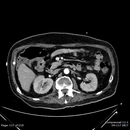 Adrenal metastasis (Radiopaedia 78425-91079 Axial C+ arterial phase 47).jpg