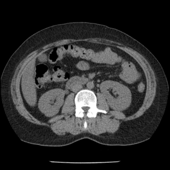 File:Adrenal myelolipoma (Radiopaedia 43401-46759 Axial non-contrast 42).jpg