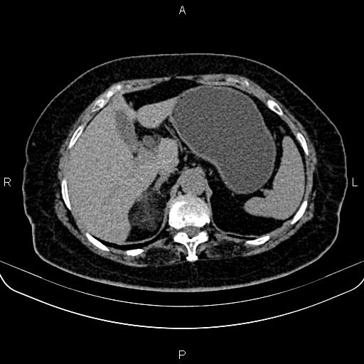 Adrenal myelolipoma (Radiopaedia 82742-96986 Axial non-contrast 36).jpg