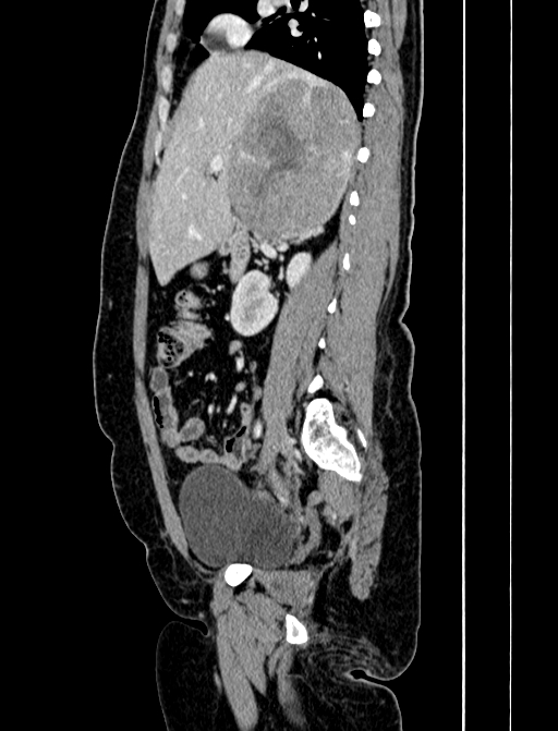 Adrenocortical carcinoma (Radiopaedia 87281-103569 Sagittal C+ portal venous phase 105).jpg