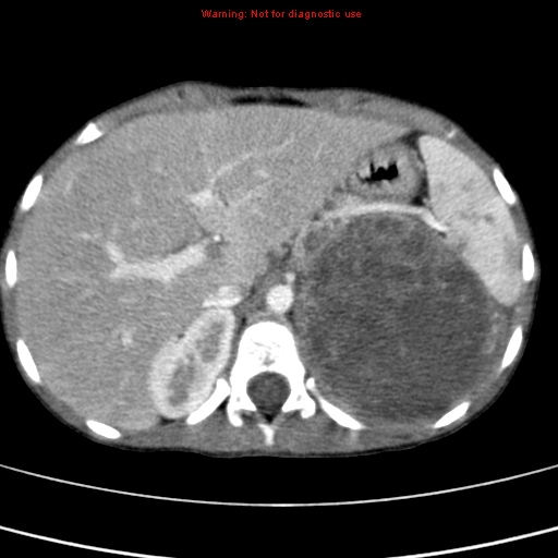 File:Adrenocortical carcinoma (Radiopaedia 9449-10131 Axial C+ portal venous phase 14).jpg