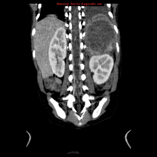 File:Adrenocortical carcinoma (Radiopaedia 9449-10131 Coronal C+ portal venous phase 16).jpg