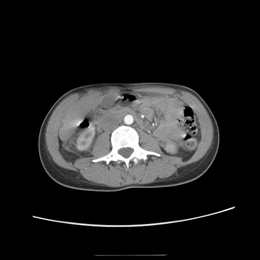 File:Adult polycystic kidney disease (Radiopaedia 48845-53876 Axial renal cortical phase 33).jpg