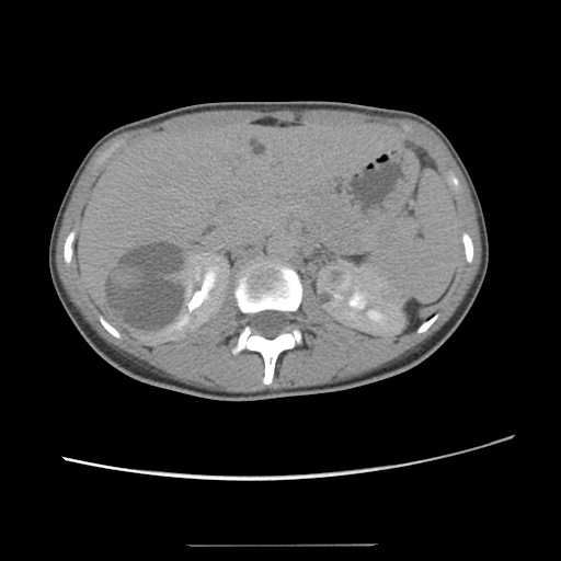 Adult polycystic kidney disease (Radiopaedia 48845-53876 Axial renal excretory phase 32).jpg