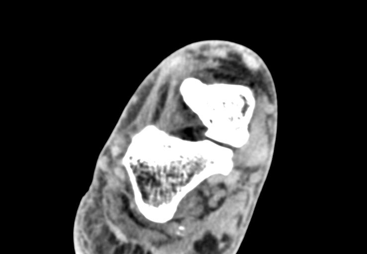 File:Advanced osteomyelitis due to open metatarsal fracture (Radiopaedia 83891-99095 Axial non-contrast 12).jpg