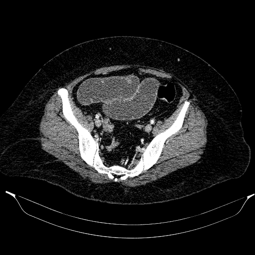 Afferent loop syndrome - secondary to incarcerated trocar site hernia (Radiopaedia 82959-97305 Axial C+ portal venous phase 191).jpg
