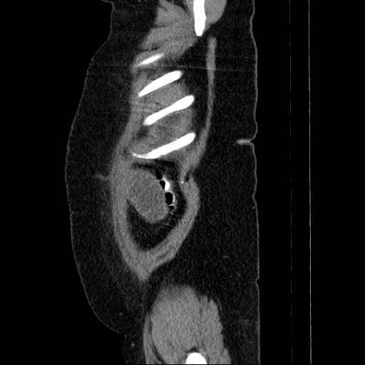 Afferent loop syndrome - secondary to incarcerated trocar site hernia (Radiopaedia 82959-97305 Sagittal C+ portal venous phase 10).jpg