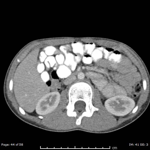 File:Agenesis of the gallbladder (Radiopaedia 55454-61905 Axial 28).jpg