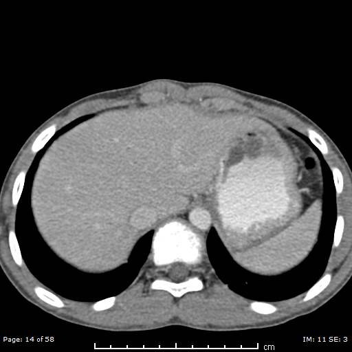 File:Agenesis of the gallbladder (Radiopaedia 55454-61905 B 14).jpg