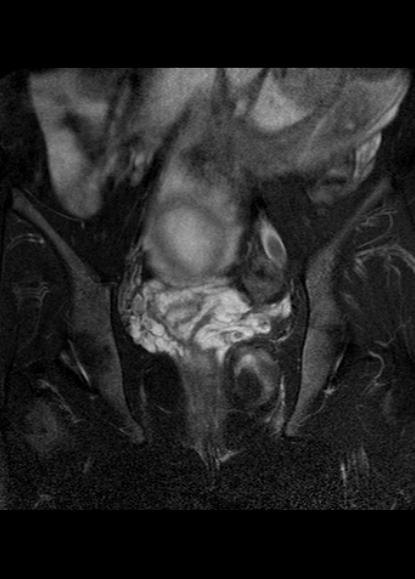 File:Aggressive angiomyxoma of the pelvis and perineum (Radiopaedia 59162-66479 Coronal T2 fat sat 16).jpg