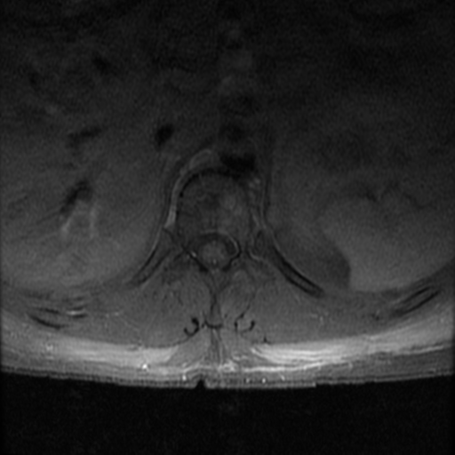 File:Aggressive vertebral hemangioma (Radiopaedia 39937-42404 Axial T1 C+ fat sat 9).png
