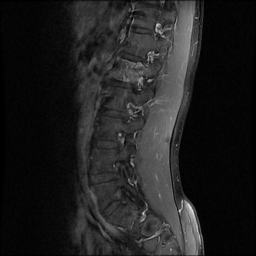 File:Aggressive vertebral hemangioma with pathological fracture (Radiopaedia 69528-79411 F 9).jpg