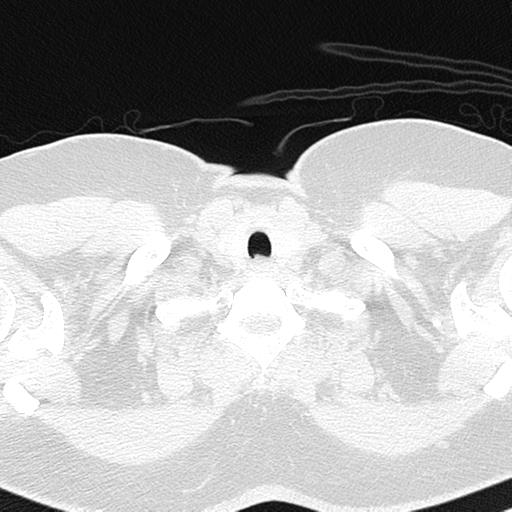File:Air trapping in small airway disease (Radiopaedia 61685-69694 Axial lung window 4).jpg