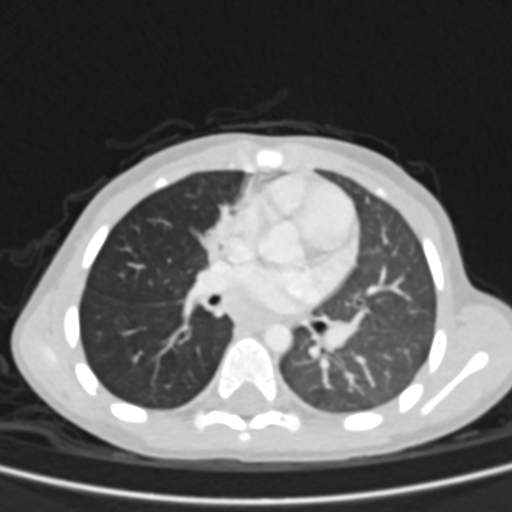 Airway foreign body (Radiopaedia 72128-82638 Axial lung window 43).jpg