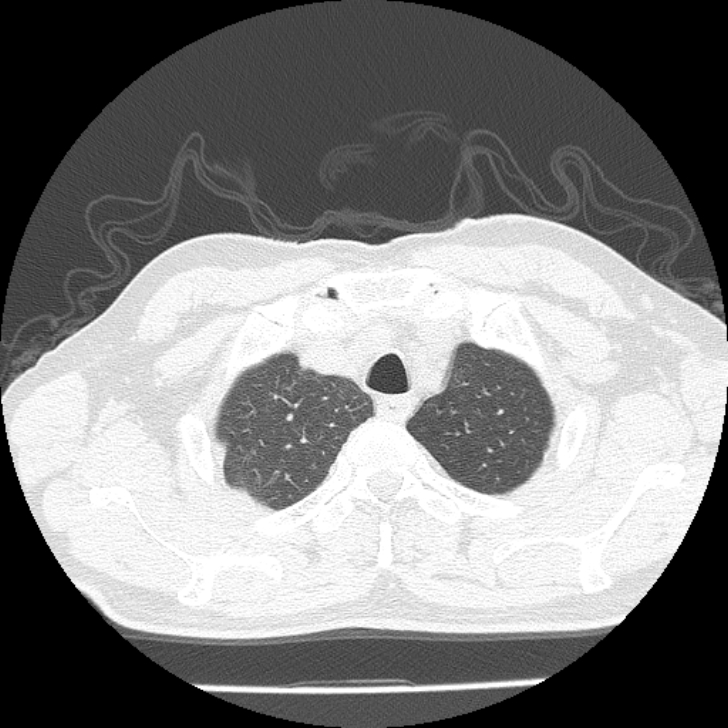 Airway foreign body in adult (Radiopaedia 85907-101779 Axial lung window 6).jpg