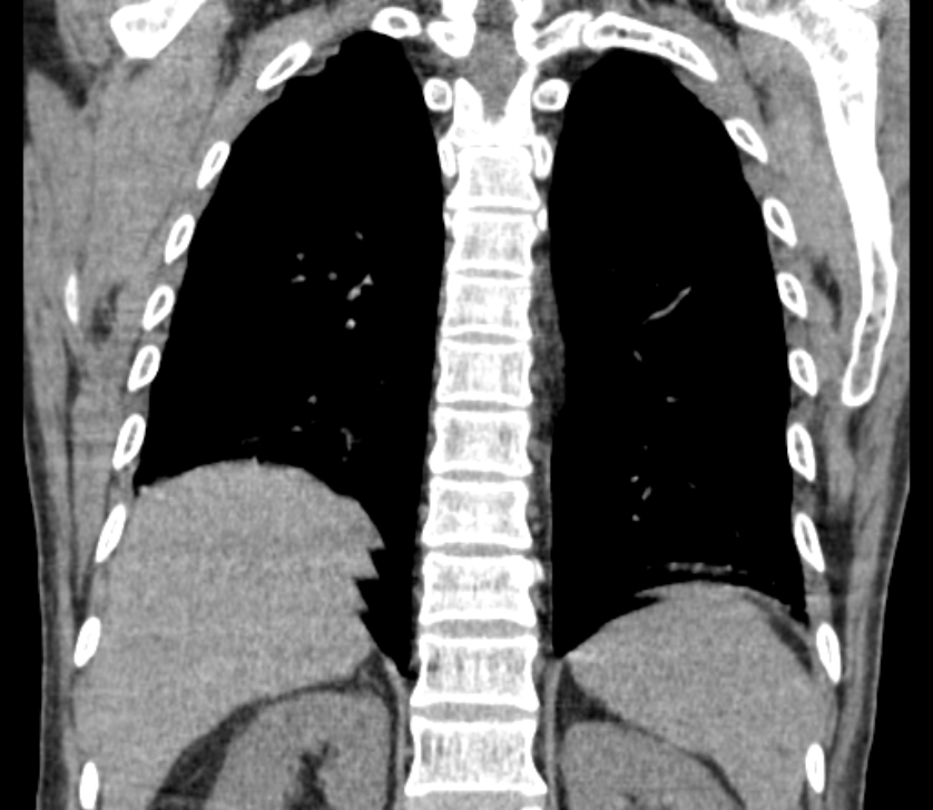 Airway foreign body in adult (Radiopaedia 85907-101779 Coronal liver window 204).jpg