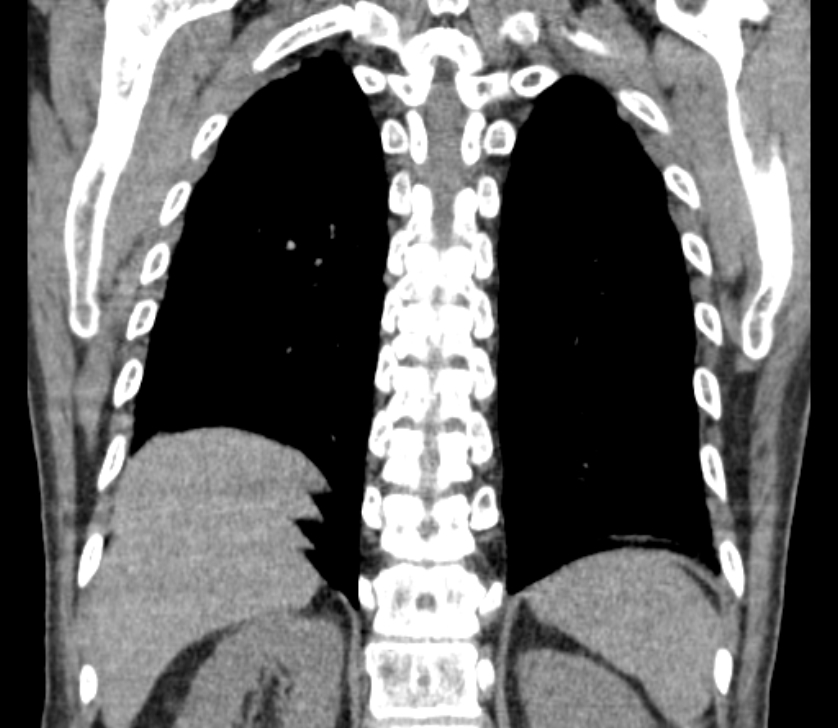 Airway foreign body in adult (Radiopaedia 85907-101779 Coronal liver window 217).jpg