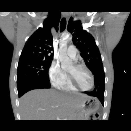 File:Alagille syndrome with pulmonary hypertension (Radiopaedia 49384-54980 C 2).jpg