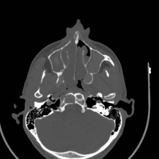 Allergic fungal sinusitis (Radiopaedia 88725-105456 Axial bone window 14).jpg