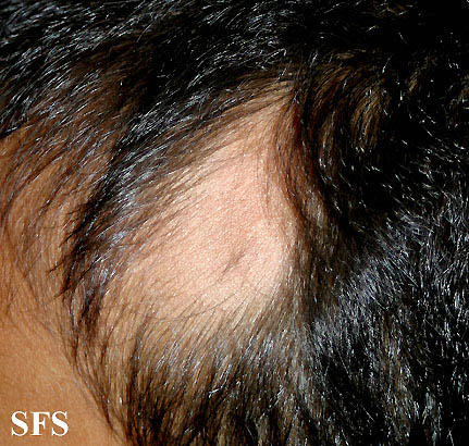 Alopecia Triangularis Congenita (Dermatology Atlas 2).jpg