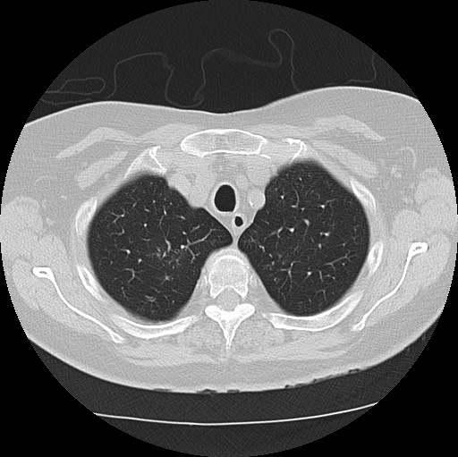 File:Alpha-1-antitrypsin deficiency (Radiopaedia 72058-82557 Axial lung window 11).jpg