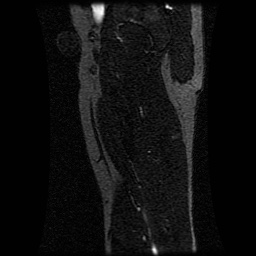 Alveolar soft part sarcoma (Radiopaedia 64501-73678 D 42).jpg