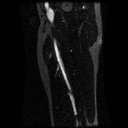 Alveolar soft part sarcoma (Radiopaedia 64501-73678 D 50).jpg