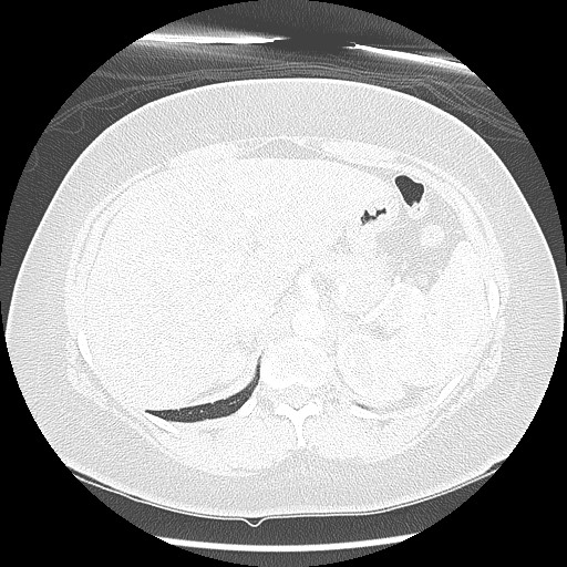 Alveolar soft part sarcoma - right leg (Radiopaedia 59432-67091 Axial lung window 109).jpg