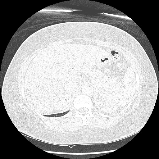 Alveolar soft part sarcoma - right leg (Radiopaedia 59432-67091 Axial lung window 112).jpg