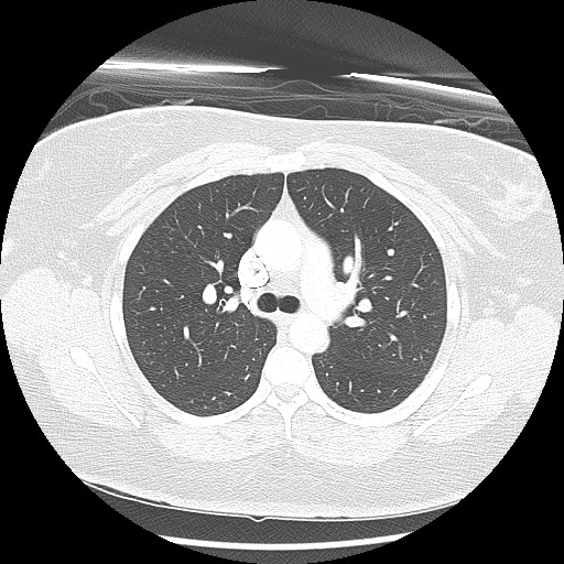 Alveolar soft part sarcoma - right leg (Radiopaedia 59432-67091 Axial lung window 41).jpg