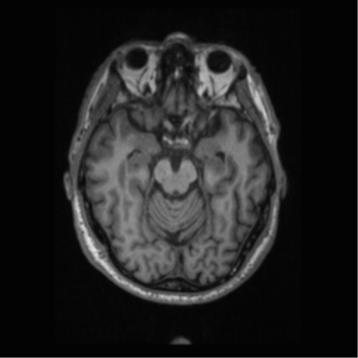 Alzheimer disease - probable (Radiopaedia 35334-36837 Axial T1 31).png