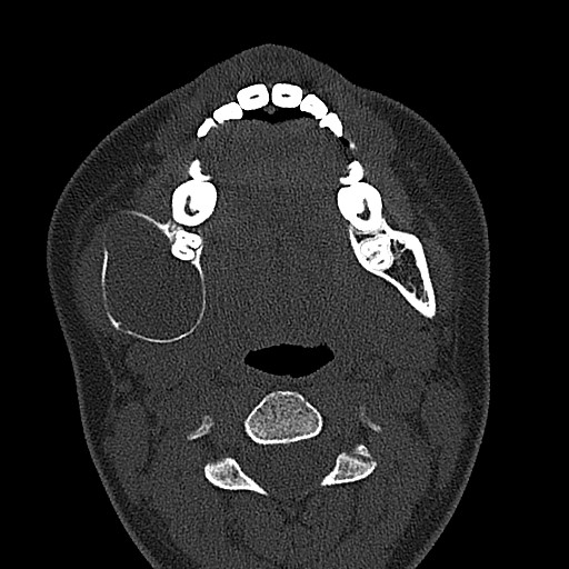 File:Ameloblastoma (Radiopaedia 26645-26793 E 41).jpg