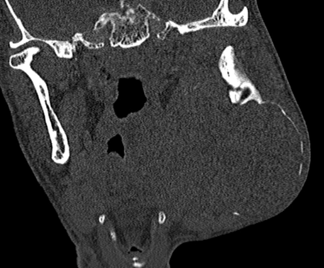 Ameloblastoma (Radiopaedia 51921-57766 Coronal bone window 165).jpg