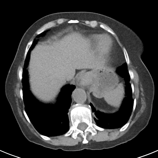 File:Ampullary adenocarcinoma (Radiopaedia 34013-35237 Axial non-contrast 7).png