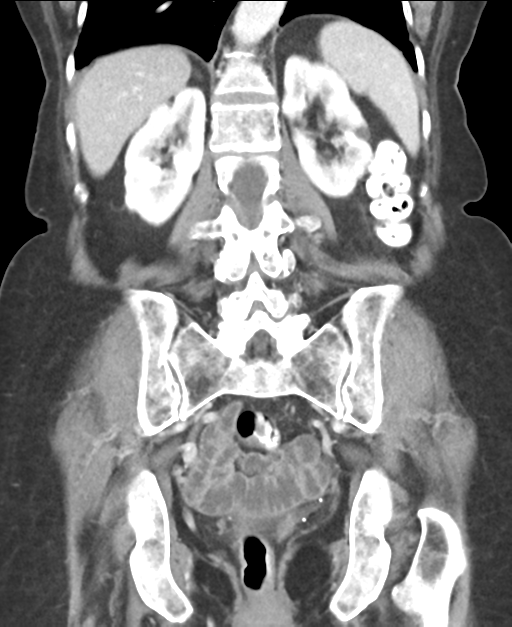 Ampullary adenocarcinoma (Radiopaedia 34013-35237 E 36).png