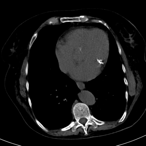 File:Ampullary adenocarcinoma (Radiopaedia 34013-35241 AXIAL THICK 1).png