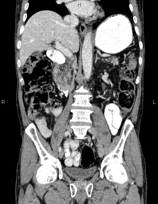 Ampullary adenocarcinoma (Radiopaedia 86093-102032 C 36).jpg